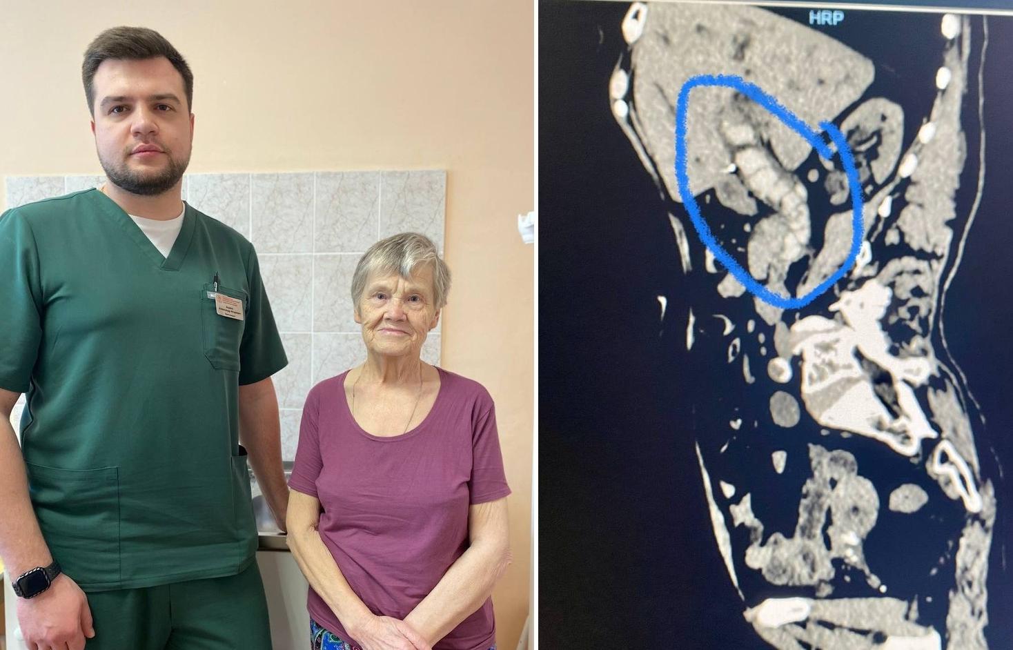 В Твери 85-летней пациентке успешно провели опасную операцию по удалению камней из желчных протоков - новости Афанасий