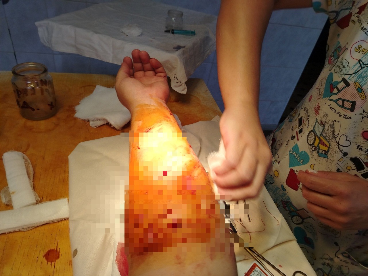 Бастрыкин взял на контроль проверку по факту нападения собаки на людей в Тверской области Фото: травмированная рука пострадавшей