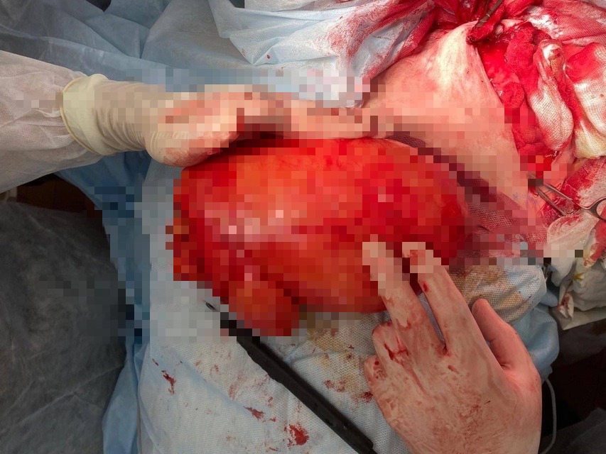 Гигантскую 4-килограммовую липому удалили в Твери хирурги у 66-летней пациентки Фото: ГКБ №6, Тверь Гигантскую 4-килограммовую липому удалили в Твери хирурги у 66-летней пациентки Фото: ГКБ №6, Тверь