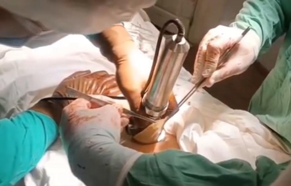 В Твери врачи спасли девушку с 40% ожогов тела 