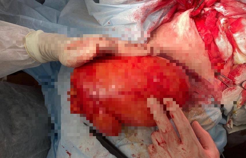 Гигантскую 4-килограммовую липому удалили в Твери хирурги у 66-летней пациентки - новости Афанасий